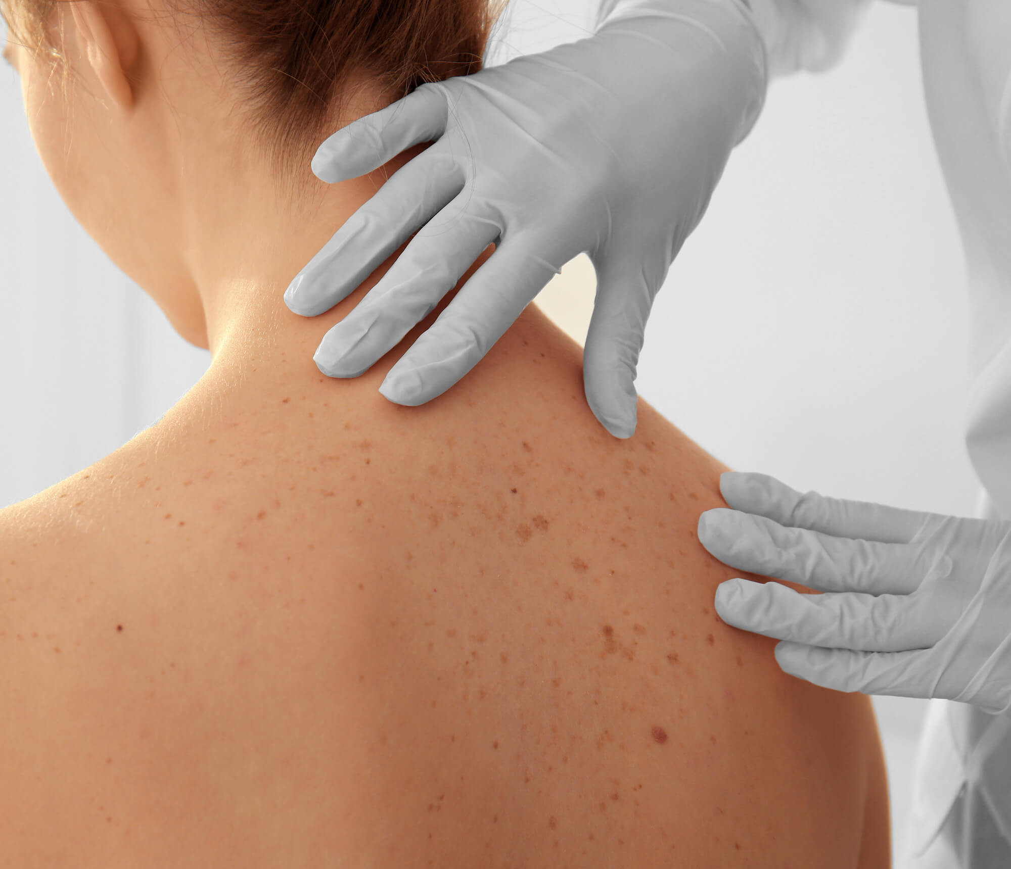 Photo of a woman's back being checked for skin cancer