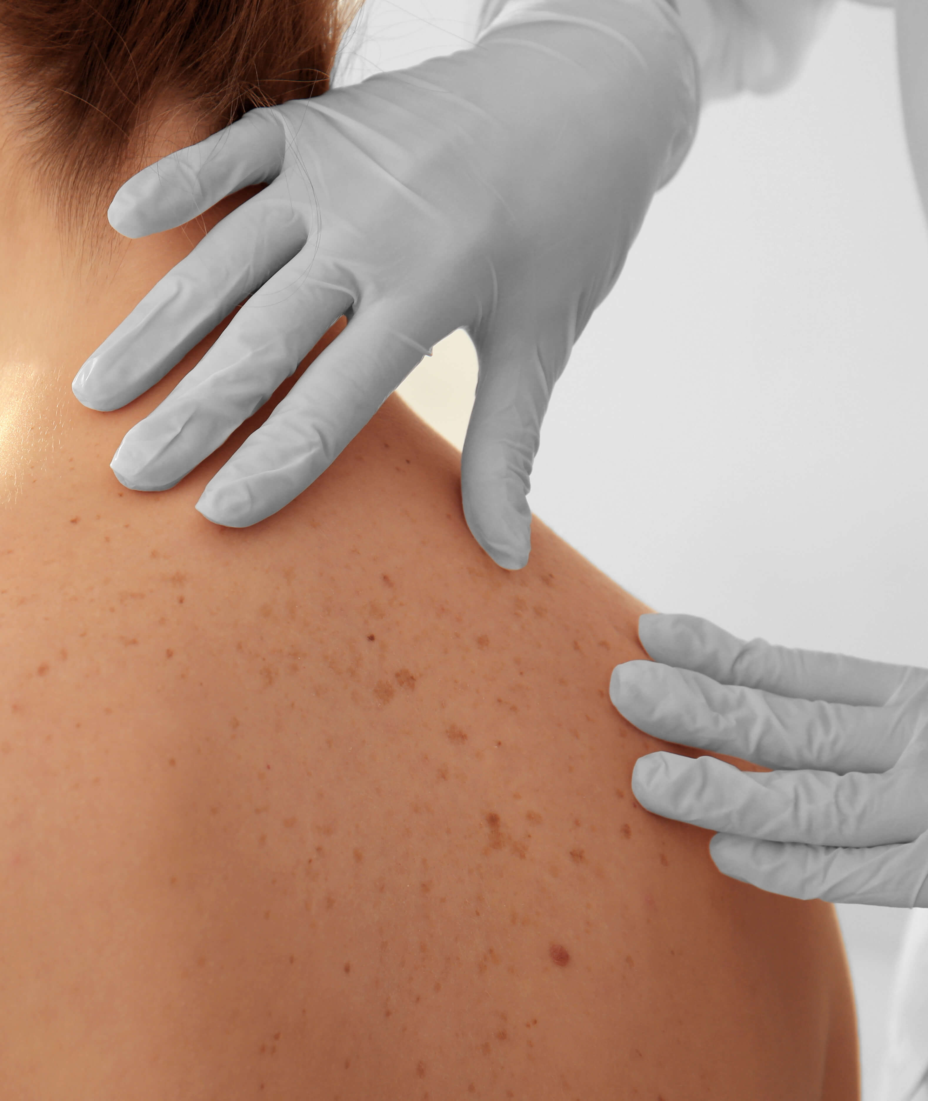 Photo of a patient being screened for skin cancer