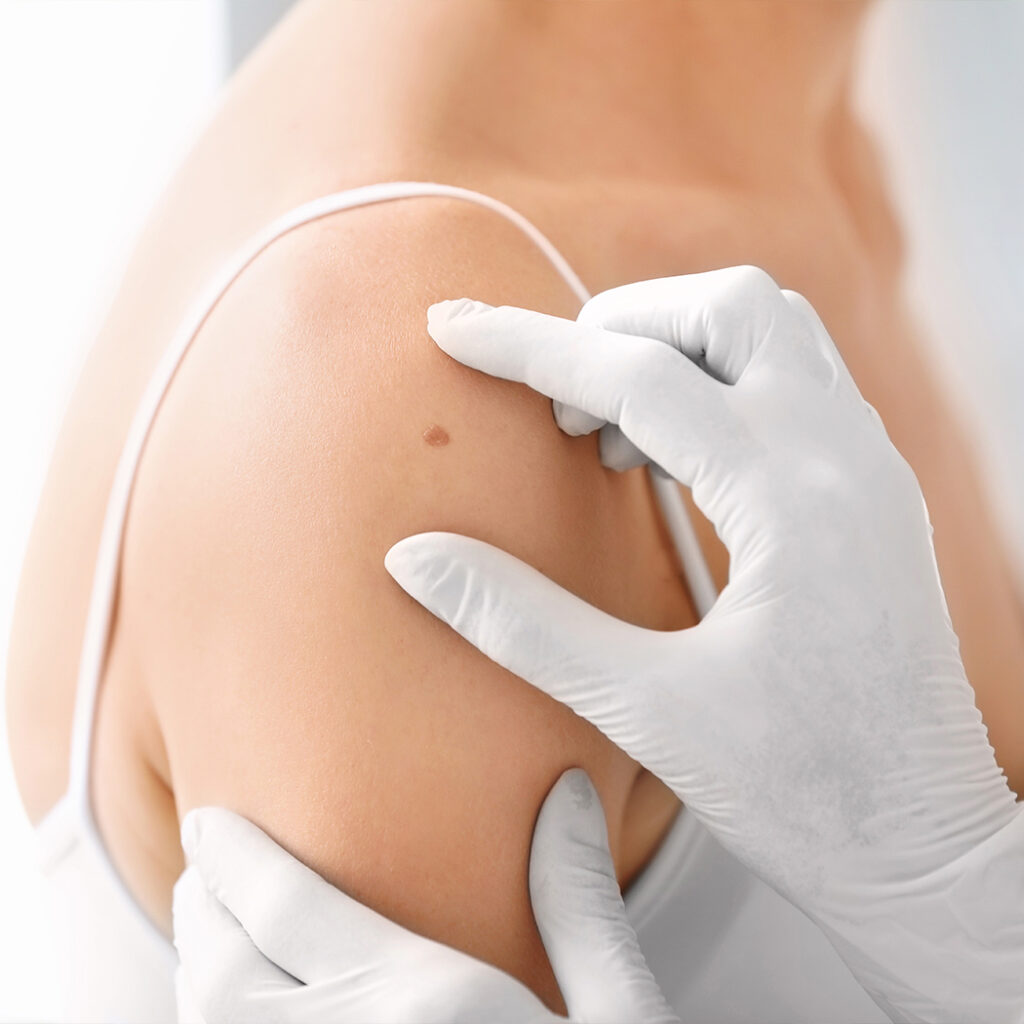 Photo of a dermatologist checking a patient's skin