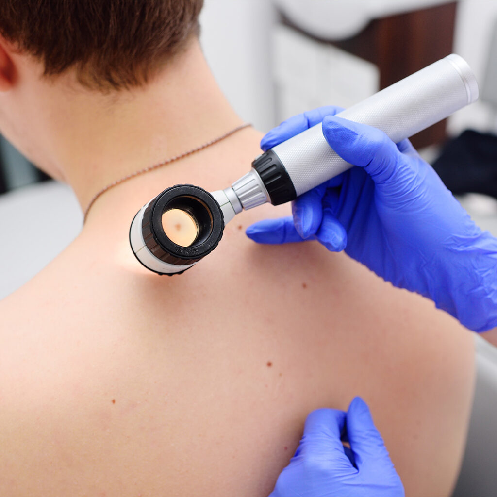 Photo of a dermatologist checking for skin cancer on a male patient