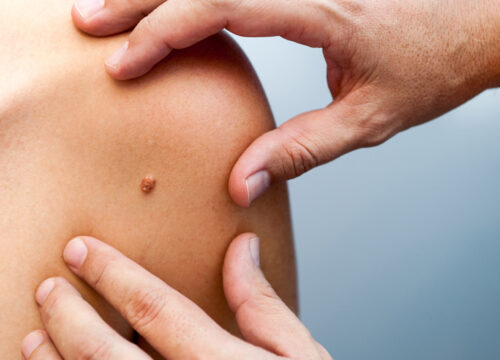 Photo of a dermatologist checking for skin cancer