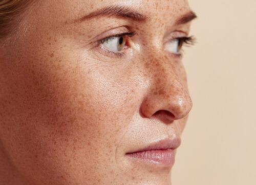 Photo of a woman's face with freckles and pigmentation