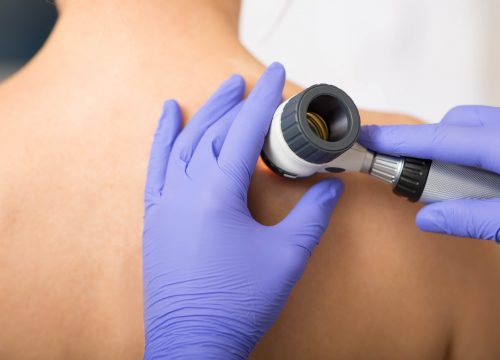 Photo of a dermatologist checking for melanoma